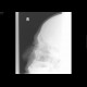 Fracture of nasal bones, comminuted: X-ray - Plain radiograph